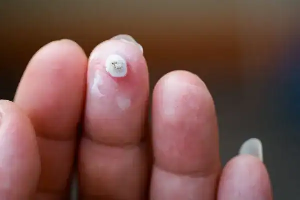 Image of white wart before cryopen treatment Lincoln