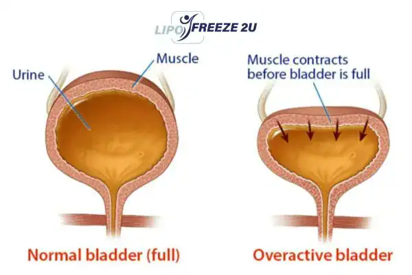 diagram of overactive bladder treatment Lincoln