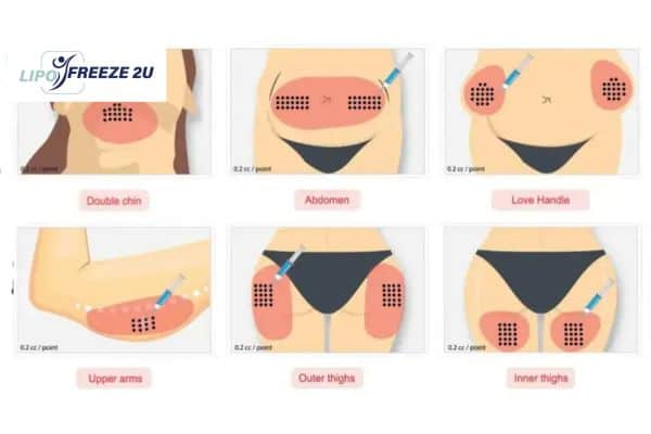 Benefits of Choosing Aqualyx for Fat Reduction Lincoln