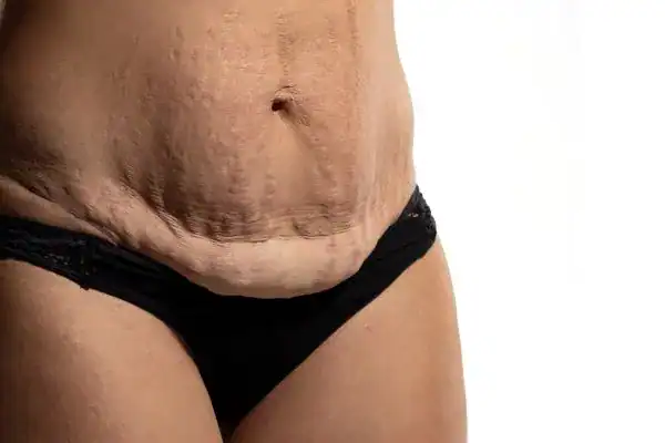 loose skin after weight loss injections Lincoln