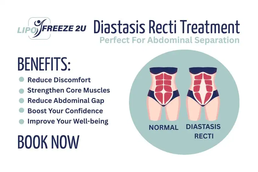Benefits of body toning treatment Lincoln for Diastasis recti