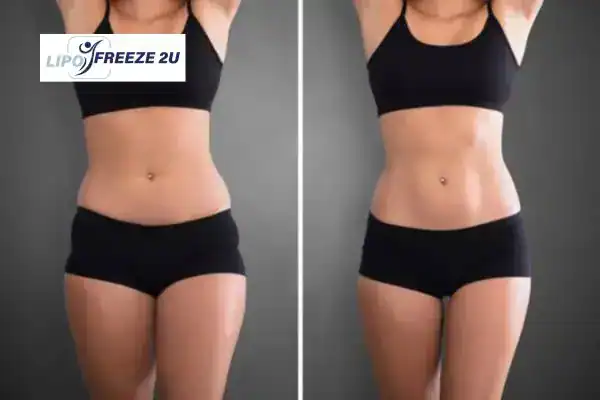 How Can LIPO FREEZE 2U Support Your Post-Pregnancy Body Recovery Lincoln?