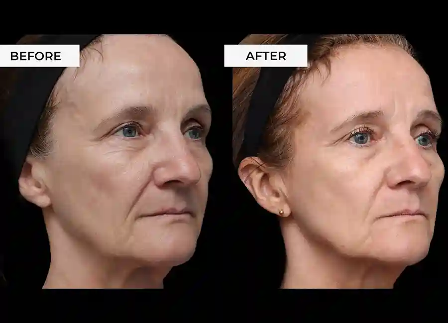 How Many RF Microneedling Sessions Will You Need to See a Difference Lincoln?