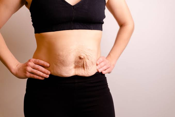 Is Surgery Really the Only Way to Repair Diastasis Recti Lincoln?