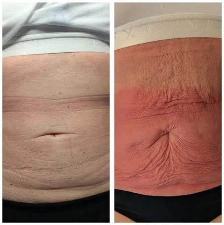 How Does RF Microneedling Improve Crepey, Thin and Uneven Skin Texture Lincoln?