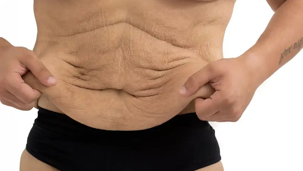 Why Does Weight Loss Medication Leave Some People With Loose or Sagging Skin Lincoln?